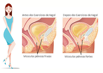 Antes e Depois dos Exercícios de Kegel