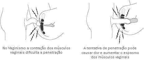 Vaginismo e Dispareunia